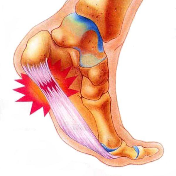 Cuidados Pela Vida - Fascite plantar é um processo inflamatório ou  degenerativo que afeta a fáscia plantar causando dor na sola do pé e no  calcanhar. Confira algumas medidas para preveni-la.